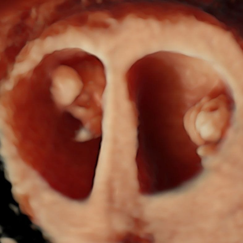 Early Pregnancy Scans
