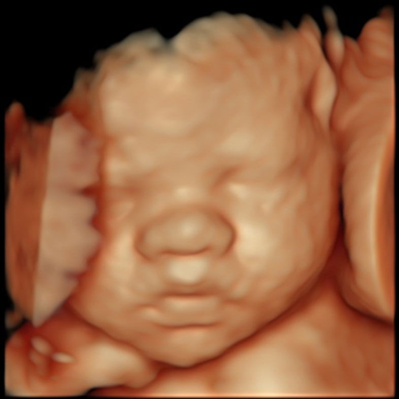 3D baby ultrasound at London Pregnancy Clinic. Please note that in some cases after 30 weeks it would be impossible to get 3D/4D images due to fetal position or other reasons