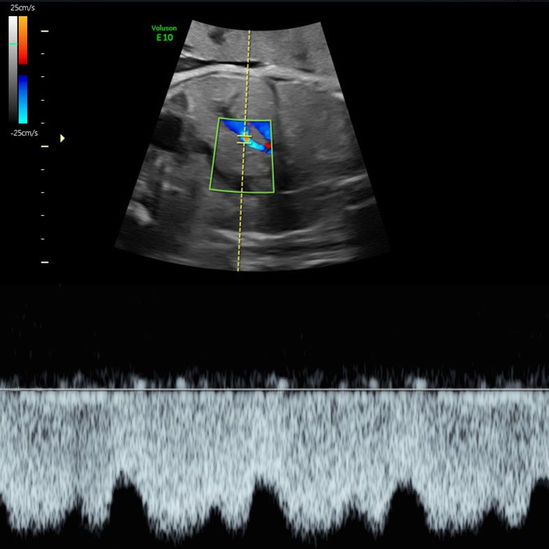 Fetal Doppler studies of Ductus Venosus blood flow at London Pregnancy Clinic'sWellbeing Scan