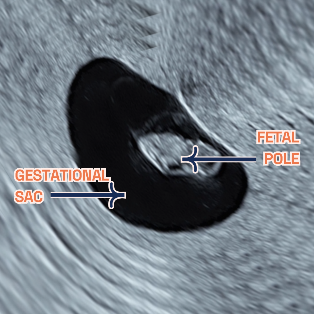 Image showing Intrauterine pregnancy at 7 weeks of pregnancy on ultrasound. It shows an Ultrasound image by London Pregnancy Clinic that shows the gestational sac, fetal pole and yolk sac - for educational purpose.