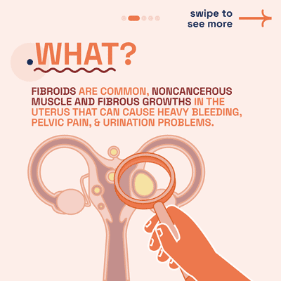 What are Fibroids - Diagram explaining fibroids with a magnifying glass examining the uterus