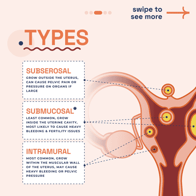 Types of Fibroids - Diagram showing subserosal, submucosal, and intramural fibroids in the uterus